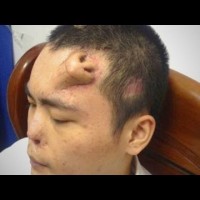 NOSE GROWN ON MAN’S FOREHEAD!